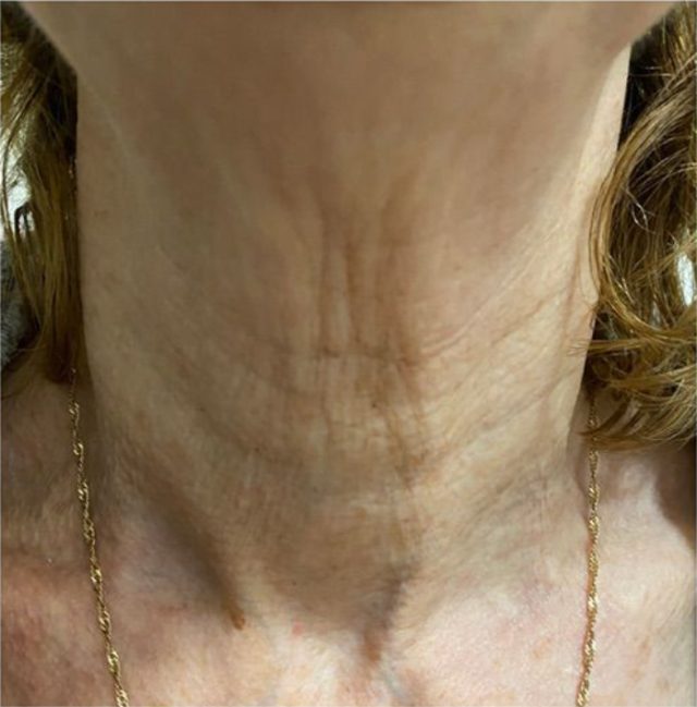 microneedling-01-after-640x649