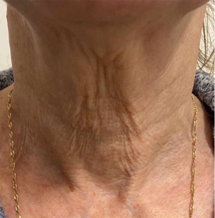 microneedling-01-before